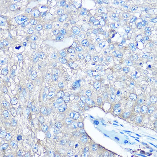 Immunohistochemistry: Seryl tRNA synthetase Antibody [NBP3-35334] - Immunohistochemistry analysis of paraffin-embedded Human lung cancer using Seryl tRNA synthetase Rabbit pAb at dilution of 1:100 (40x lens). High pressure antigen retrieval performed with 0.01M Citrate Bufferr (pH 6.0) prior to IHC staining.