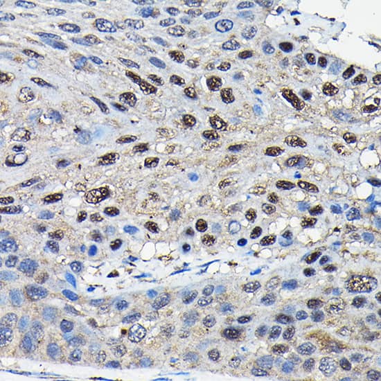 Immunohistochemistry: Suppressor of Fused Antibody [NBP3-35342] - Immunohistochemistry analysis of paraffin-embedded Human esophageal cancer using Suppressor of Fused Rabbit pAb at dilution of 1:100 (40x lens). High pressure antigen retrieval performed with 0.01M Citrate Bufferr (pH 6.0) prior to IHC staining.