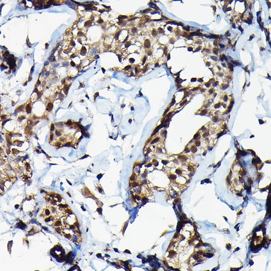 Immunohistochemistry: Suppressor of Fused Antibody [NBP3-35342] - Immunohistochemistry analysis of paraffin-embedded Human breast cancer using Suppressor of Fused Rabbit pAb at dilution of 1:100 (40x lens). High pressure antigen retrieval performed with 0.01M Citrate Bufferr (pH 6.0) prior to IHC staining.