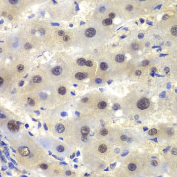 Immunohistochemistry: CKII alpha prime polypeptide Antibody [NBP3-35347] - Immunohistochemistry analysis of paraffin-embedded Human liver cancer using CKII alpha prime polypeptide Rabbit pAb at dilution of 1:100 (40x lens). Microwave antigen retrieval performed with 0.01M PBS Buffer (pH 7.2) prior to IHC staining.