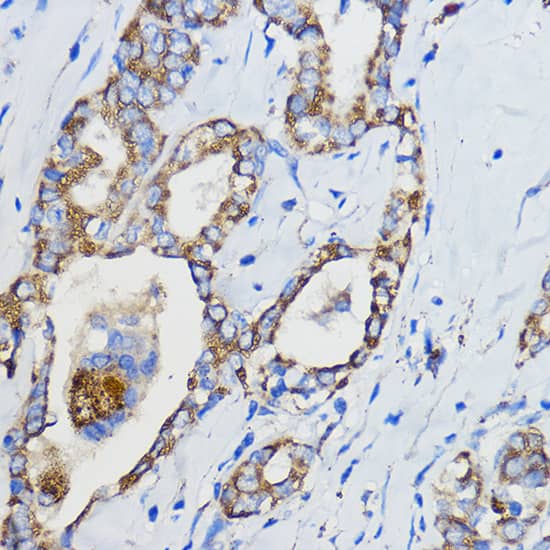 Immunohistochemistry: CYP51A1 Antibody [NBP3-35348] - Immunohistochemistry analysis of paraffin-embedded Human thyroid cancer using CYP51A1 Rabbit pAb at dilution of 1:50 (40x lens). Microwave antigen retrieval performed with 0.01M PBS Buffer (pH 7.2) prior to IHC staining.