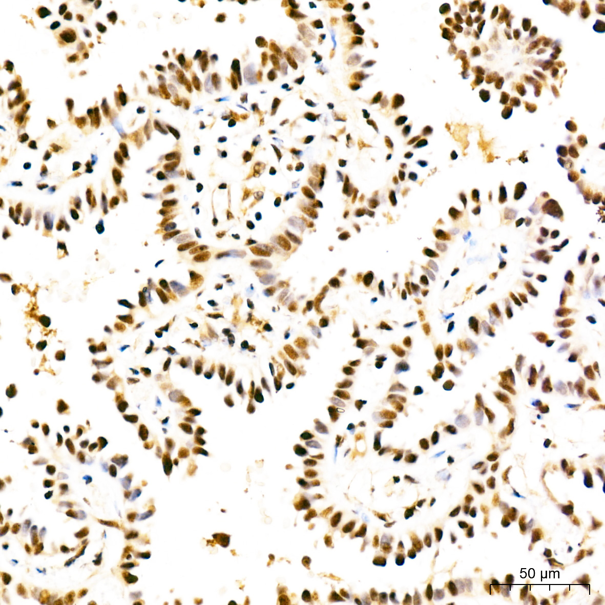 Immunohistochemistry: USF1 Antibody [NBP3-35360] - Immunohistochemistry analysis of USF1 in paraffin-embedded human lung cancer tissue using USF1 Rabbit pAb at a dilution of 1:100 (40x lens). High pressure antigen retrieval was performed with 0.01 M citrate buffer (pH 6.0) prior to IHC staining.