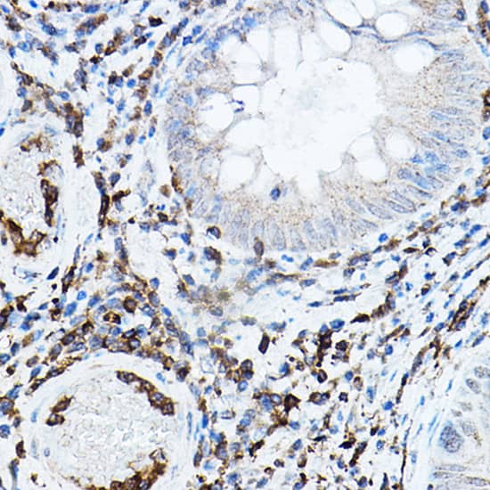 Immunohistochemistry: PKC beta Antibody [NBP3-35369] - Immunohistochemistry analysis of paraffin-embedded Human colon carcinoma using PKC beta Rabbit pAb at dilution of 1:50 (40x lens). High pressure antigen retrieval performed with 0.01M Citrate Bufferr (pH 6.0) prior to IHC staining.