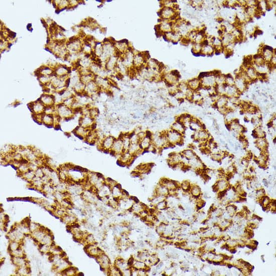 Immunohistochemistry: HMGCS2 Antibody [NBP3-35423] - Immunohistochemistry analysis of paraffin-embedded Human colon carcinoma using HMGCS2 Rabbit pAb at dilution of 1:100 (40x lens). Microwave antigen retrieval performed with 0.01M PBS Buffer (pH 7.2) prior to IHC staining.