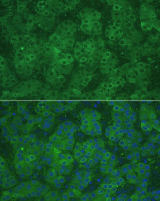 Immunocytochemistry/ Immunofluorescence: CBS Antibody [NBP3-35425] - Immunofluorescence analysis of paraffin-embedded human liver cancer using CBS Rabbit pAb at dilution of 1:100 (40x lens). Secondary antibody: Cy3-conjugated Goat anti-Rabbit IgG (H+L) at 1:500 dilution. Blue: DAPI for nuclear staining.