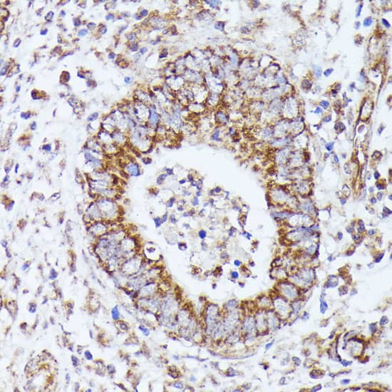 Immunohistochemistry: Pyruvate Dehydrogenase E2 Antibody [NBP3-35442] - Immunohistochemistry analysis of paraffin-embedded Human thyroid cancer tissue using Pyruvate Dehydrogenase E2 Rabbit pAb at a dilution of 1:200 (40x lens). High pressure antigen retrieval performed with 0.01M Citrate Bufferr (pH 6.0) prior to IHC staining.