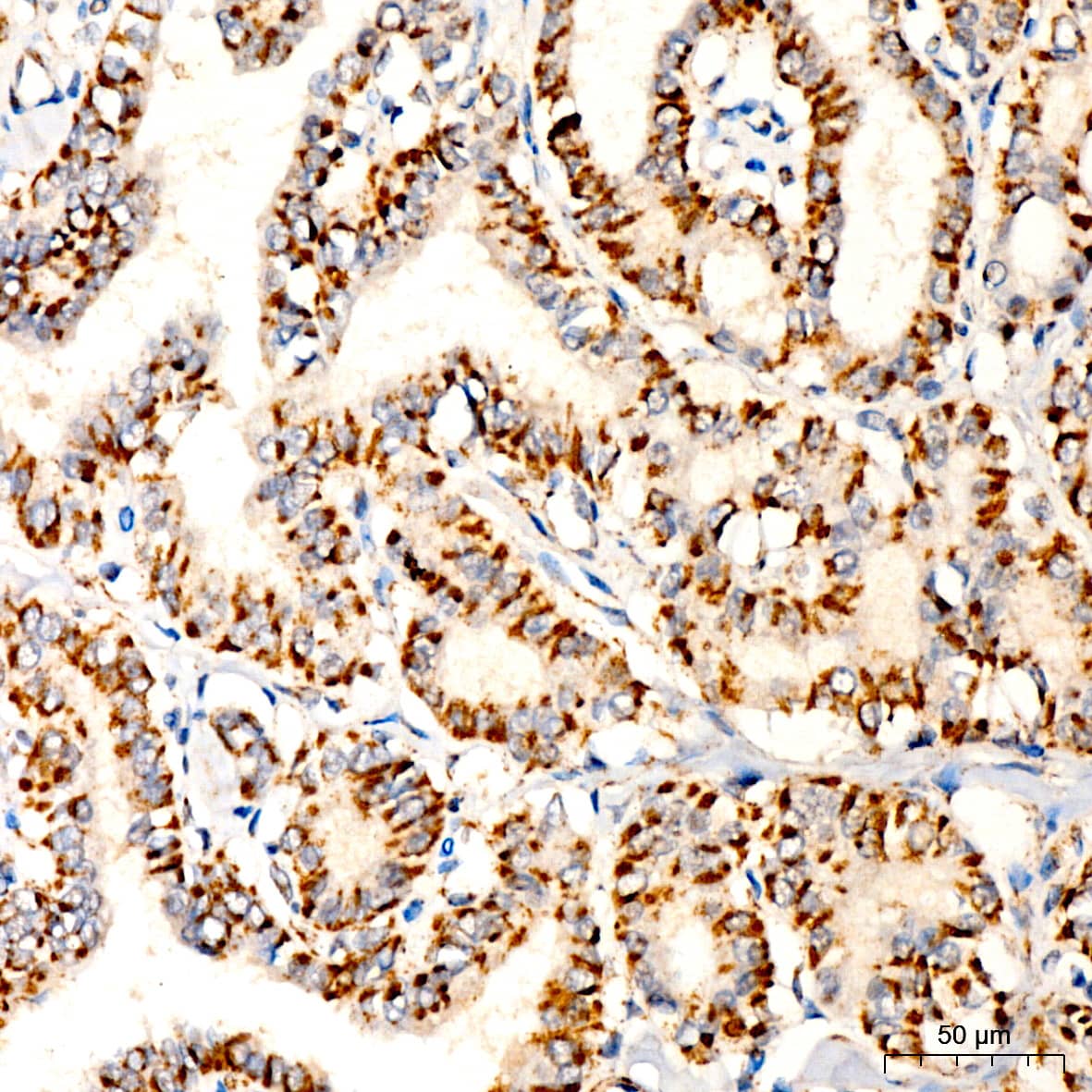 Immunohistochemistry: Pyruvate Dehydrogenase E2 Antibody [NBP3-35442] - Immunohistochemistry analysis of paraffin-embedded Human thyroid cancer tissue using Pyruvate Dehydrogenase E2 Rabbit pAb at a dilution of 1:200 (40x lens). High pressure antigen retrieval performed with 0.01M Citrate Bufferr (pH 6.0) prior to IHC staining.