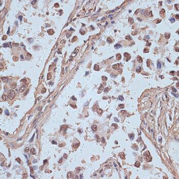 Immunohistochemistry: SNW1 Antibody [NBP3-35445] - Immunohistochemistry analysis of paraffin-embedded Human lung cancer using SNW1 Rabbit pAb at dilution of 1:100 (40x lens). Microwave antigen retrieval performed with 0.01M PBS Buffer (pH 7.2) prior to IHC staining.