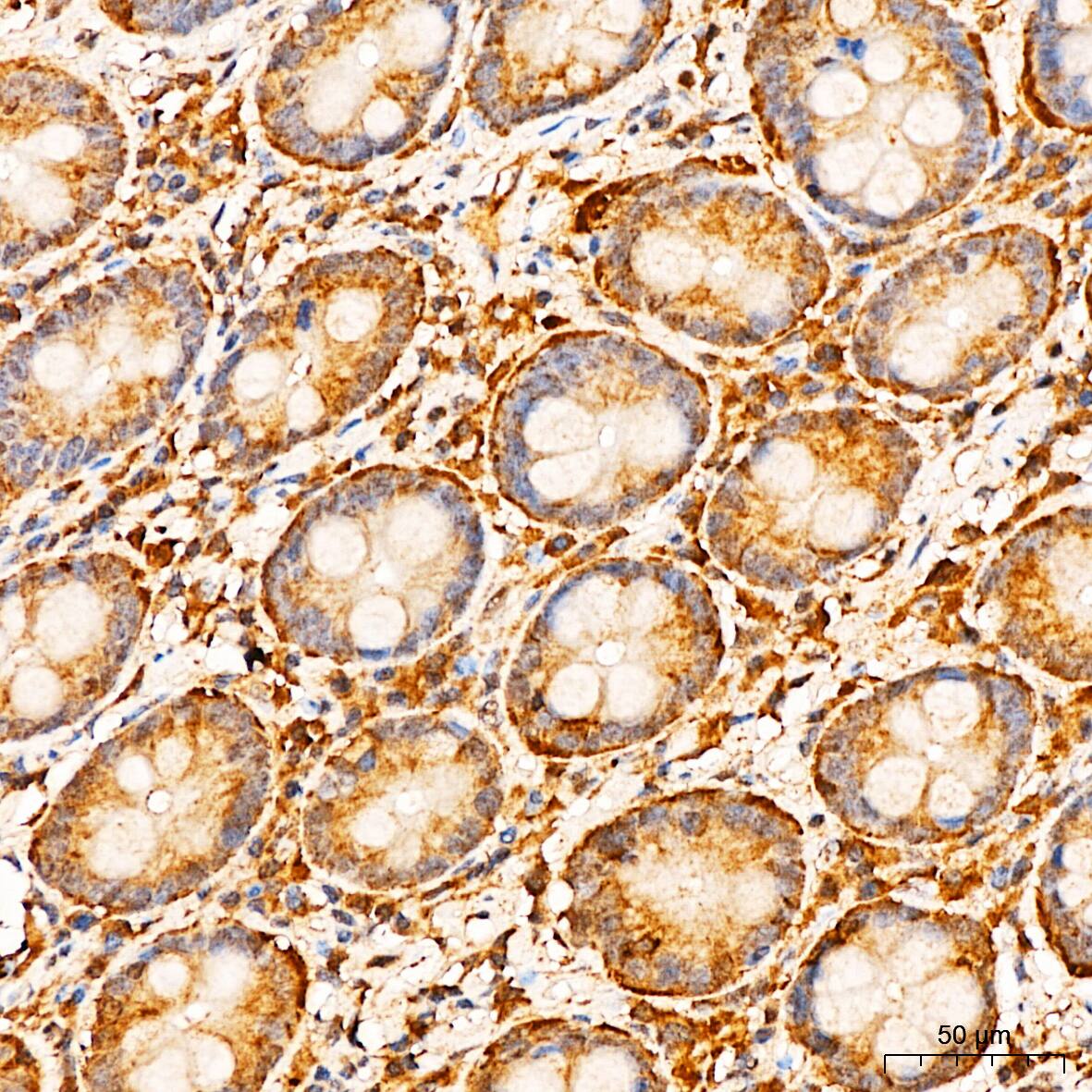 Immunohistochemistry: APOBEC3G Antibody [NBP3-35447] - Immunohistochemistry analysis of paraffin-embedded Human colon tissue using APOBEC3G Rabbit pAb at a dilution of 1:300 (40x lens). High pressure antigen retrieval performed with 0.01M Citrate Bufferr (pH 6.0) prior to IHC staining.