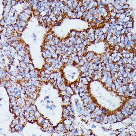 Immunohistochemistry: IDH3A Antibody [NBP3-35451] - Immunohistochemistry analysis of paraffin-embedded Human colon carcinoma using IDH3A Rabbit pAb at dilution of 1:100 (40x lens). Microwave antigen retrieval performed with 0.01M PBS Buffer (pH 7.2) prior to IHC staining.