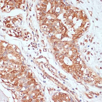 Immunohistochemistry: PTPRN2 Antibody [NBP3-35468] - Immunohistochemistry analysis of paraffin-embedded Human mammary cancer using PTPRN2 Rabbit pAb at dilution of 1:100 (40x lens). Microwave antigen retrieval performed with 0.01M PBS Buffer (pH 7.2) prior to IHC staining.