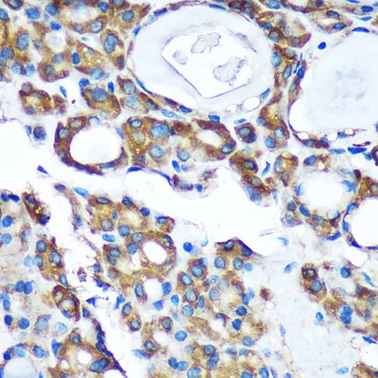 Immunohistochemistry: PDXDC1 Antibody [NBP3-35475] - Immunohistochemistry analysis of paraffin-embedded Human thyroid cancer using PDXDC1 Rabbit pAb at dilution of 1:100 (40x lens). Microwave antigen retrieval performed with 0.01M PBS Buffer (pH 7.2) prior to IHC staining.