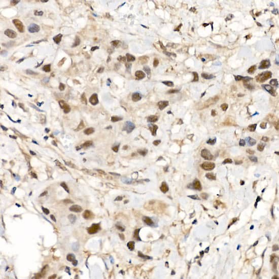 Immunohistochemistry: CrkRS Antibody [NBP3-35482] - Immunohistochemistry analysis of paraffin-embedded Human breast cancer using CrkRS Rabbit pAb at dilution of 1:500 (40x lens). High pressure antigen retrieval performed with 0.01M Citrate Bufferr (pH 6.0) prior to IHC staining.