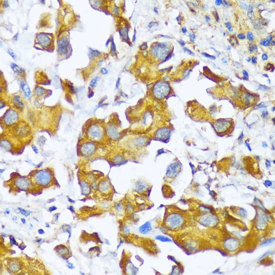 Immunohistochemistry: Alanyl tRNA synthetase Antibody [NBP3-35492] - Immunohistochemistry analysis of paraffin-embedded Human lung cancer using Alanyl tRNA synthetase Rabbit pAb at dilution of 1:100 (40x lens). Microwave antigen retrieval performed with 0.01M PBS Buffer (pH 7.2) prior to IHC staining.