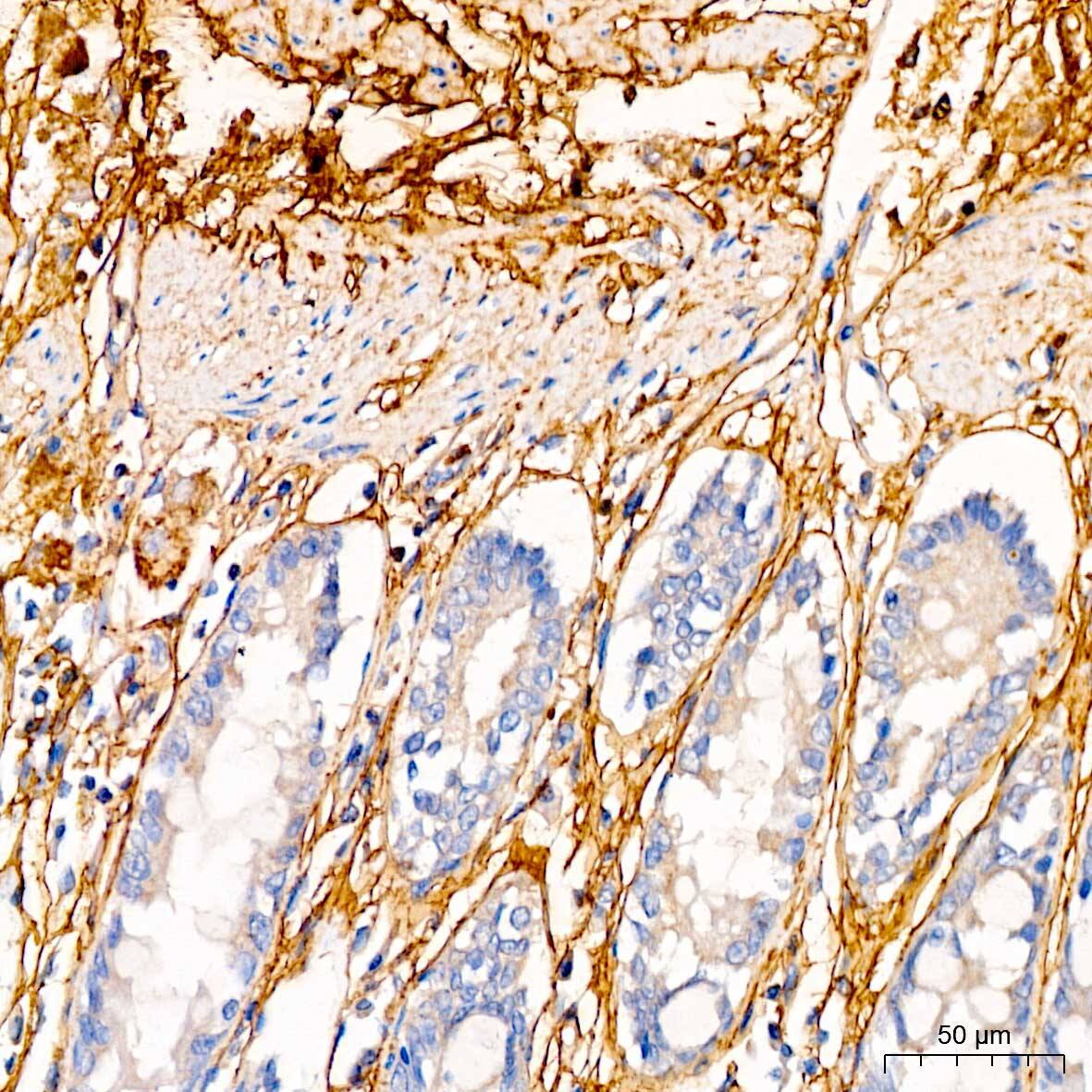 Immunohistochemistry: Decorin Neo Antibody [NBP3-35494] - Immunohistochemistry analysis of paraffin-embedded Human colon using Decorin Neo Rabbit pAb at dilution of 1:50 (40x lens). High pressure antigen retrieval performed with 0.01M Citrate Bufferr (pH 6.0) prior to IHC staining.