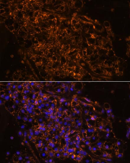 Immunocytochemistry/ Immunofluorescence: epithelial Sodium Channel gamma Antibody [NBP3-35497] - Immunofluorescence analysis of paraffin-embedded human kidney cancer using epithelial Sodium Channel gamma Rabbit pAb at dilution of 1:100. Secondary antibody: Cy3-conjugated Goat anti-Rabbit IgG (H+L) at 1:500 dilution. Blue: DAPI for nuclear staining.