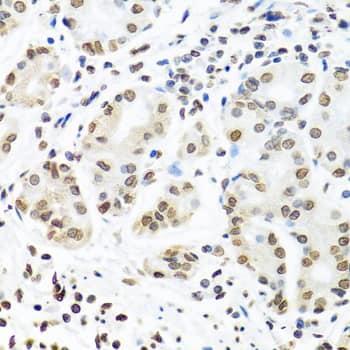 Immunohistochemistry: IGF2BP1 Antibody [NBP3-35508] - Immunohistochemistry analysis of paraffin-embedded Human stomach using IGF2BP1 Rabbit pAb at dilution of 1:100 (40x lens). Microwave antigen retrieval performed with 0.01M PBS Buffer (pH 7.2) prior to IHC staining.