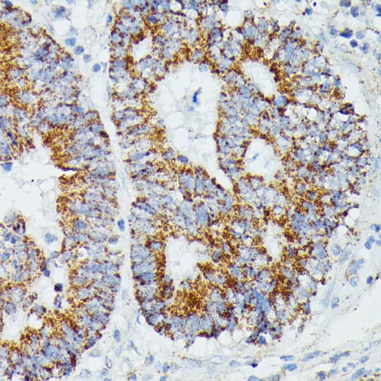 Immunohistochemistry: IVD Antibody [NBP3-35522] - Immunohistochemistry analysis of paraffin-embedded Human colon carcinoma using IVD Rabbit pAb at dilution of 1:100 (40x lens). Microwave antigen retrieval performed with 0.01M PBS Buffer (pH 7.2) prior to IHC staining.