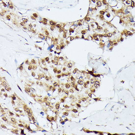 Immunohistochemistry: KIF22 Antibody [NBP3-35523] - Immunohistochemistry analysis of paraffin-embedded Human breast cancer using KIF22 Rabbit pAb at dilution of 1:100 (40x lens). Microwave antigen retrieval performed with 0.01M PBS Buffer (pH 7.2) prior to IHC staining.