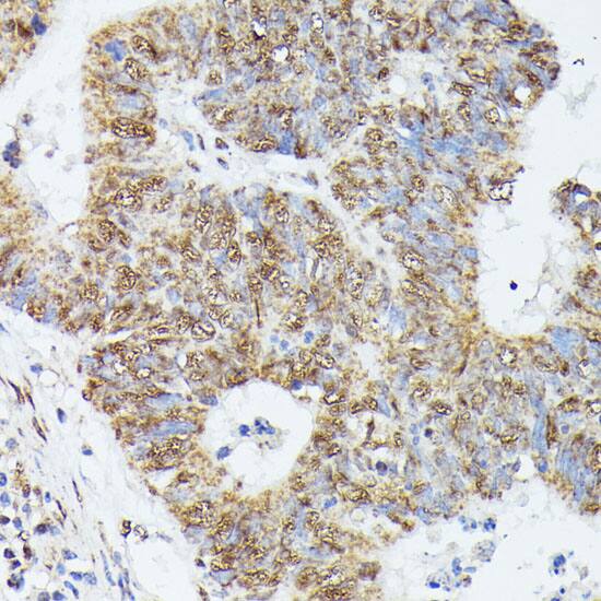 Immunohistochemistry: KIF22 Antibody [NBP3-35523] - Immunohistochemistry analysis of paraffin-embedded Human colon carcinoma using KIF22 Rabbit pAb at dilution of 1:100 (40x lens). Microwave antigen retrieval performed with 0.01M PBS Buffer (pH 7.2) prior to IHC staining.