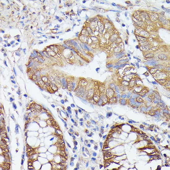 Immunohistochemistry: ASC1 Antibody [NBP3-35533] - Immunohistochemistry analysis of paraffin-embedded Human colon carcinoma using ASC1 Rabbit pAb at dilution of 1:100 (40x lens). Microwave antigen retrieval performed with 0.01M PBS Buffer (pH 7.2) prior to IHC staining.