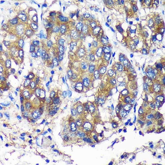 Immunohistochemistry: SEC23IP Antibody [NBP3-35544] - Immunohistochemistry analysis of paraffin-embedded Human liver cancer using SEC23IP Rabbit pAb at dilution of 1:100 (40x lens). Microwave antigen retrieval performed with 0.01M PBS Buffer (pH 7.2) prior to IHC staining.