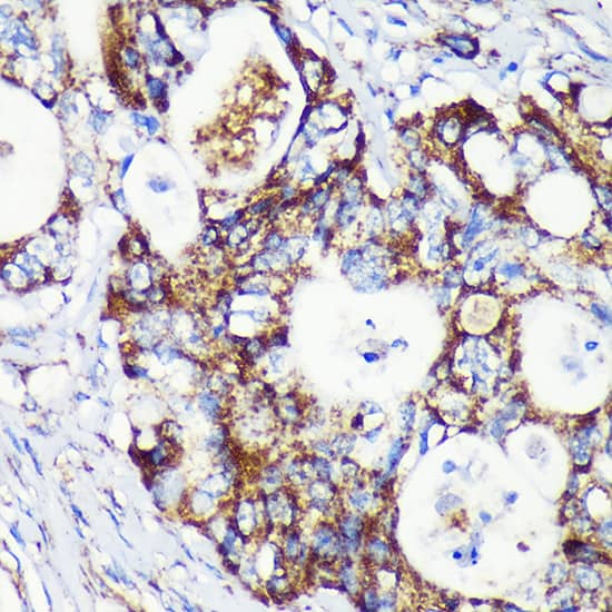 Immunohistochemistry: CCDC44 Antibody [NBP3-35553] - Immunohistochemistry analysis of paraffin-embedded Human colon carcinoma using CCDC44 Rabbit pAb at dilution of 1:100 (40x lens). Microwave antigen retrieval performed with 0.01M PBS Buffer (pH 7.2) prior to IHC staining.