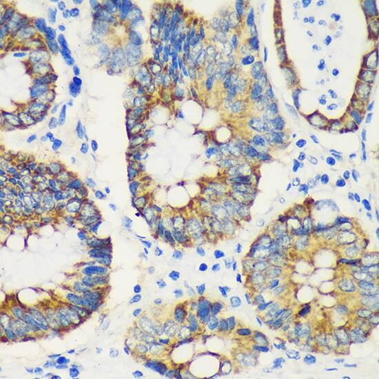 Immunohistochemistry: USP47 Antibody [NBP3-35557] - Immunohistochemistry analysis of paraffin-embedded Human colon carcinoma using USP47 Rabbit pAb at dilution of 1:100 (40x lens). Microwave antigen retrieval performed with 0.01M PBS Buffer (pH 7.2) prior to IHC staining.