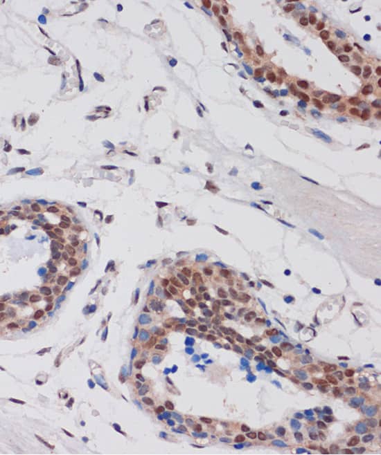 Immunohistochemistry: ARID1B Antibody [NBP3-35563] - Immunohistochemistry analysis of paraffin-embedded Human breast using ARID1B Rabbit pAb at dilution of 1:100 (40x lens). Microwave antigen retrieval performed with 0.01M PBS Buffer (pH 7.2) prior to IHC staining.