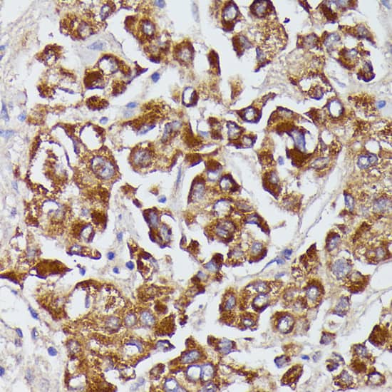 Immunohistochemistry: Serpin A8/Angiotensinogen Antibody [NBP3-35581] - Immunohistochemistry analysis of paraffin-embedded Human liver cancer using Serpin A8/Angiotensinogen Rabbit pAb at dilution of 1:100 (40x lens). Microwave antigen retrieval performed with 0.01M PBS Buffer (pH 7.2) prior to IHC staining.