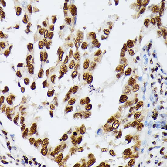 Immunohistochemistry: AUF1 Antibody [NBP3-35586] - Immunohistochemistry analysis of paraffin-embedded Human lung cancer using AUF1 Rabbit pAb at dilution of 1:100 (40x lens). Microwave antigen retrieval performed with 0.01M PBS Buffer (pH 7.2) prior to IHC staining.