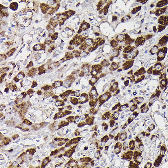 Immunohistochemistry: Monoamine Oxidase B Antibody [NBP3-35587] - Immunohistochemistry analysis of paraffin-embedded Human liver cancer using Monoamine Oxidase B(MAOB) Rabbit pAb at dilution of 1:100 (40x lens). High pressure antigen retrieval performed with 0.01M Citrate Bufferr (pH 6.0) prior to IHC staining.