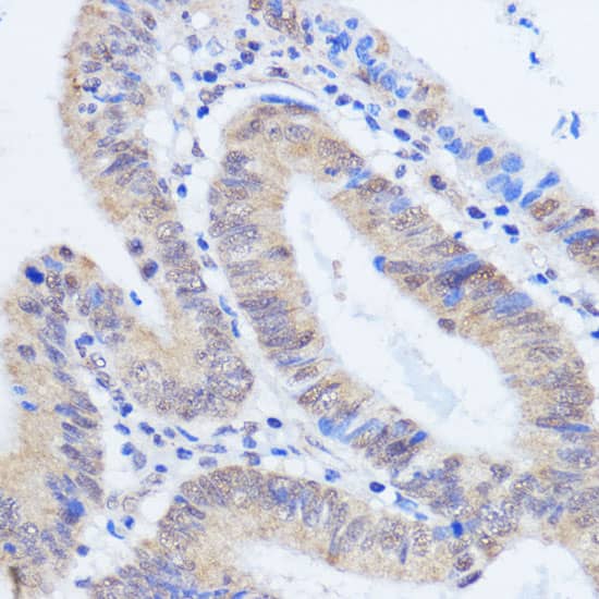 Immunohistochemistry: HCC1 Antibody [NBP3-35596] - Immunohistochemistry analysis of paraffin-embedded Human colon carcinoma using HCC1 Rabbit pAb at dilution of 1:100 (40x lens). Microwave antigen retrieval performed with 0.01M PBS Buffer (pH 7.2) prior to IHC staining.