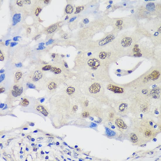 Immunohistochemistry: UCKL1 Antibody [NBP3-35608] - Immunohistochemistry analysis of paraffin-embedded Human breast cancer using UCKL1 Rabbit pAb at dilution of 1:100 (40x lens). Microwave antigen retrieval performed with 0.01M PBS Buffer (pH 7.2) prior to IHC staining.