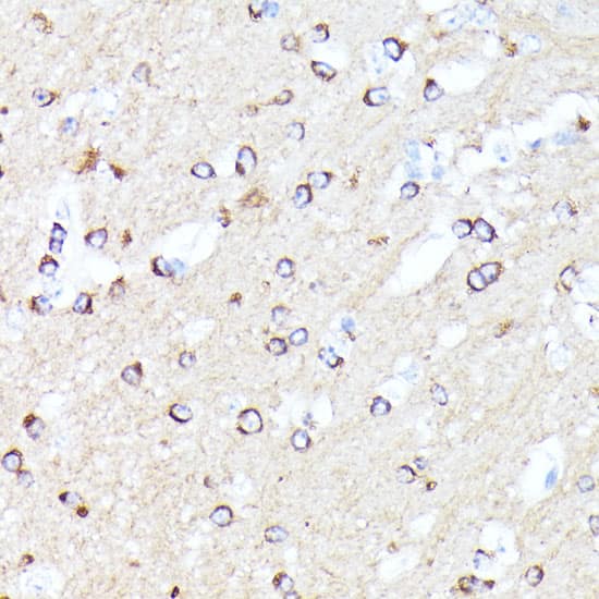 Immunohistochemistry: CCDC6 Antibody [NBP3-35636] - Immunohistochemistry analysis of paraffin-embedded Human liver cancer using CCDC6 Rabbit pAb at dilution of 1:100 (40x lens). Microwave antigen retrieval performed with 0.01M PBS Buffer (pH 7.2) prior to IHC staining.