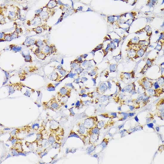 Immunohistochemistry: USP33 Antibody [NBP3-35652] - Immunohistochemistry analysis of paraffin-embedded Human breast cancer using USP33 Rabbit pAb at dilution of 1:100 (40x lens). Microwave antigen retrieval performed with 0.01M PBS Buffer (pH 7.2) prior to IHC staining.