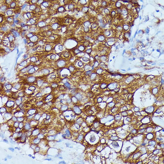 Immunohistochemistry: DDX6 Antibody [NBP3-35658] - Immunohistochemistry analysis of paraffin-embedded Human mammary cancer using DDX6 Rabbit pAb at dilution of 1:100 (40x lens). Microwave antigen retrieval performed with 0.01M PBS Buffer (pH 7.2) prior to IHC staining.