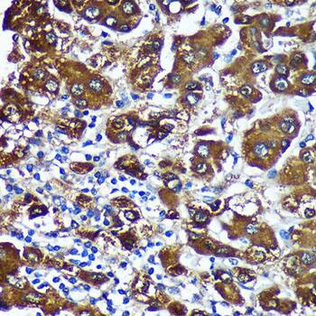 Immunohistochemistry: CTNNA3 Antibody [NBP3-35677] - Immunohistochemistry analysis of paraffin-embedded Human liver cancer using CTNNA3 Rabbit pAb at dilution of 1:100 (40x lens). Microwave antigen retrieval performed with 0.01M PBS Buffer (pH 7.2) prior to IHC staining.