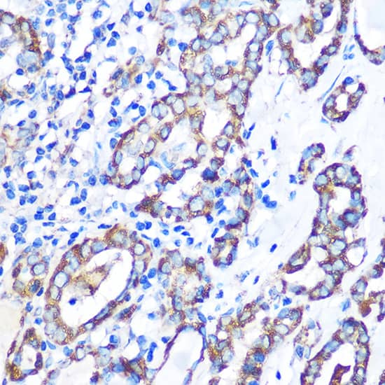 Immunohistochemistry: MST4 Antibody [NBP3-35679] - Immunohistochemistry analysis of paraffin-embedded Human thyroid cancer using MST4 Rabbit pAb at dilution of 1:100 (40x lens). Microwave antigen retrieval performed with 0.01M PBS Buffer (pH 7.2) prior to IHC staining.