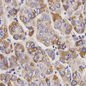 Immunohistochemistry: UGT1A9 Antibody [NBP3-35685] - Immunohistochemistry analysis of paraffin-embedded Human liver cancer using UGT1A9 Rabbit pAb at dilution of 1:200 (40x lens). Microwave antigen retrieval performed with 0.01M PBS Buffer (pH 7.2) prior to IHC staining.