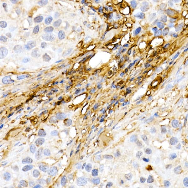 Immunohistochemistry: Decorin Antibody [NBP3-35694] - Immunohistochemistry analysis of paraffin-embedded Human breast cancer using Decorin Rabbit pAb at dilution of 1:50 (40x lens). High pressure antigen retrieval performed with 0.01M Citrate Bufferr (pH 6.0) prior to IHC staining.