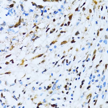 Immunohistochemistry: XRCC4 Antibody [NBP3-35698] - Immunohistochemistry analysis of paraffin-embedded Human gastric cancer using XRCC4 Rabbit pAb at dilution of 1:100 (40x lens). Microwave antigen retrieval performed with 0.01M PBS Buffer (pH 7.2) prior to IHC staining.