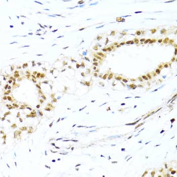 Immunohistochemistry: XRCC4 Antibody [NBP3-35698] - Immunohistochemistry analysis of paraffin-embedded Human breast cancer using XRCC4 Rabbit pAb at dilution of 1:100 (40x lens). Microwave antigen retrieval performed with 0.01M PBS Buffer (pH 7.2) prior to IHC staining.