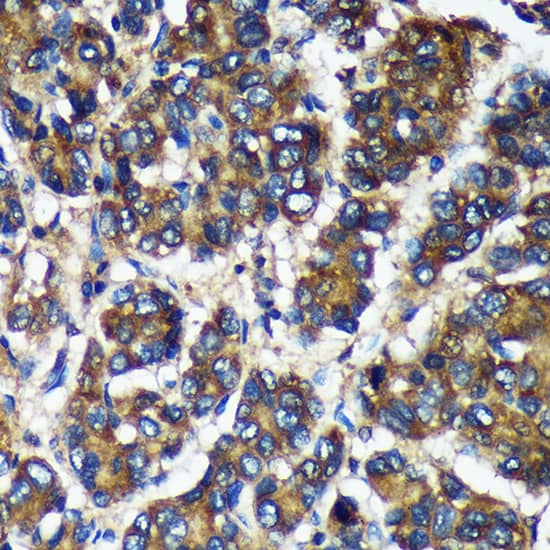 Immunohistochemistry: TMX2 Antibody [NBP3-35724] - Immunohistochemistry analysis of paraffin-embedded Human liver cancer using TMX2 Rabbit pAb at dilution of 1:100 (40x lens). Microwave antigen retrieval performed with 0.01M Tris/EDTA Buffer (pH 9.0) prior to IHC staining.