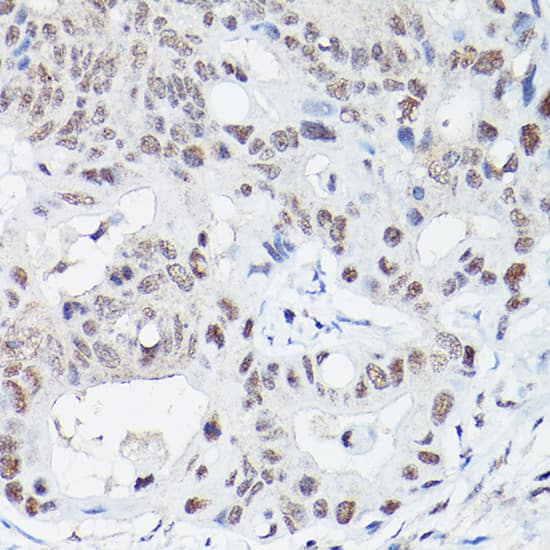 Immunohistochemistry: DNA Ligase IV Antibody [NBP3-35747] - Immunohistochemistry analysis of paraffin-embedded Human colon carcinoma using DNA Ligase IV Rabbit pAb at dilution of 1:100 (40x lens). High pressure antigen retrieval performed with 0.01M Citrate Bufferr (pH 6.0) prior to IHC staining.