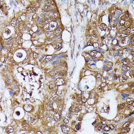 Immunohistochemistry: MAK Antibody [NBP3-35755] - Immunohistochemistry analysis of paraffin-embedded Human colon carcinoma using MAK Rabbit pAb at dilution of 1:100 (40x lens). Microwave antigen retrieval performed with 0.01M PBS Buffer (pH 7.2) prior to IHC staining.