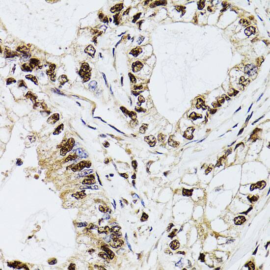 Immunohistochemistry: DCK Antibody [NBP3-35800] - Immunohistochemistry analysis of paraffin-embedded Human gastric cancer using DCK Rabbit pAb at dilution of 1:100 (40x lens). Microwave antigen retrieval performed with 0.01M PBS Buffer (pH 7.2) prior to IHC staining.