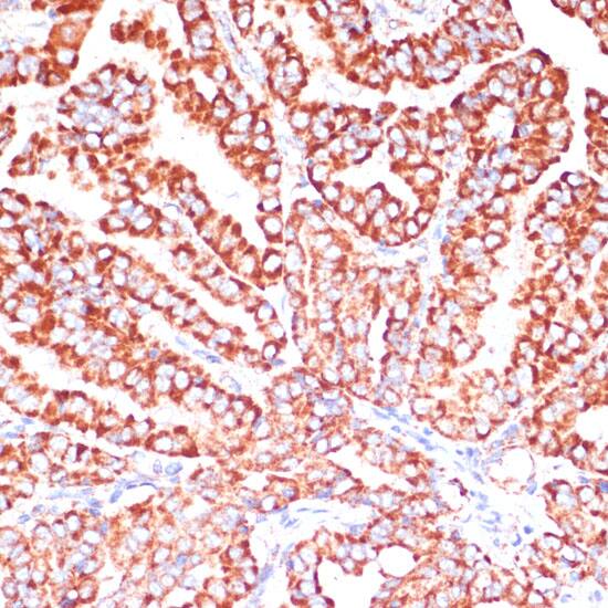 Immunohistochemistry: ARHGAP4 Antibody [NBP3-35825] - Immunohistochemistry analysis of paraffin-embedded Human thyroid cancer using ARHGAP4 Rabbit pAb at dilution of 1:100 (40x lens). Microwave antigen retrieval performed with 0.01M PBS Buffer (pH 7.2) prior to IHC staining.