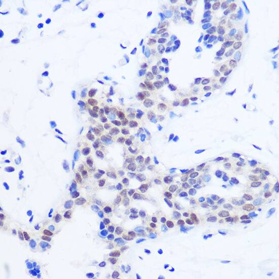 Immunohistochemistry: Splicing factor, arginine/serine-rich 11 Antibody [NBP3-35832] - Immunohistochemistry analysis of paraffin-embedded Human breast using Splicing factor, arginine/serine-rich 11 Rabbit pAb at dilution of 1:100 (40x lens). Microwave antigen retrieval performed with 0.01M PBS Buffer (pH 7.2) prior to IHC staining.