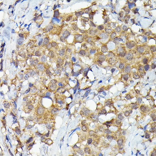 Immunohistochemistry: MNK1 Antibody [NBP3-35840] - Immunohistochemistry analysis of paraffin-embedded Human breast cancer using MNK1 Rabbit pAb at dilution of 1:50 (40x lens). High pressure antigen retrieval performed with 0.01M Citrate Bufferr (pH 6.0) prior to IHC staining.